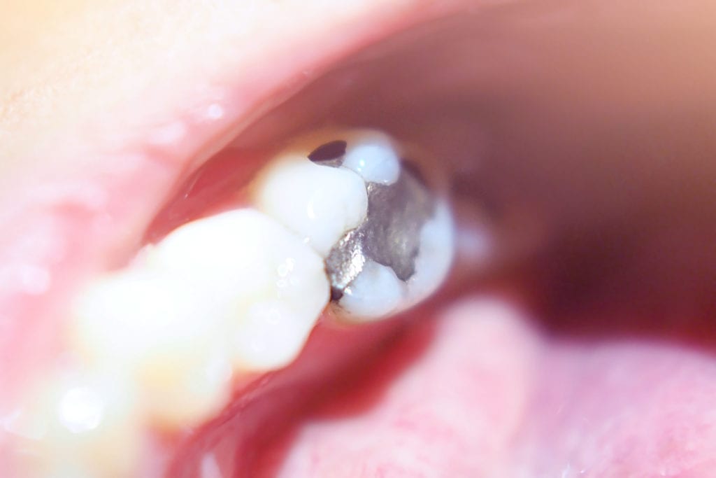 diş amalgamının doldurulması