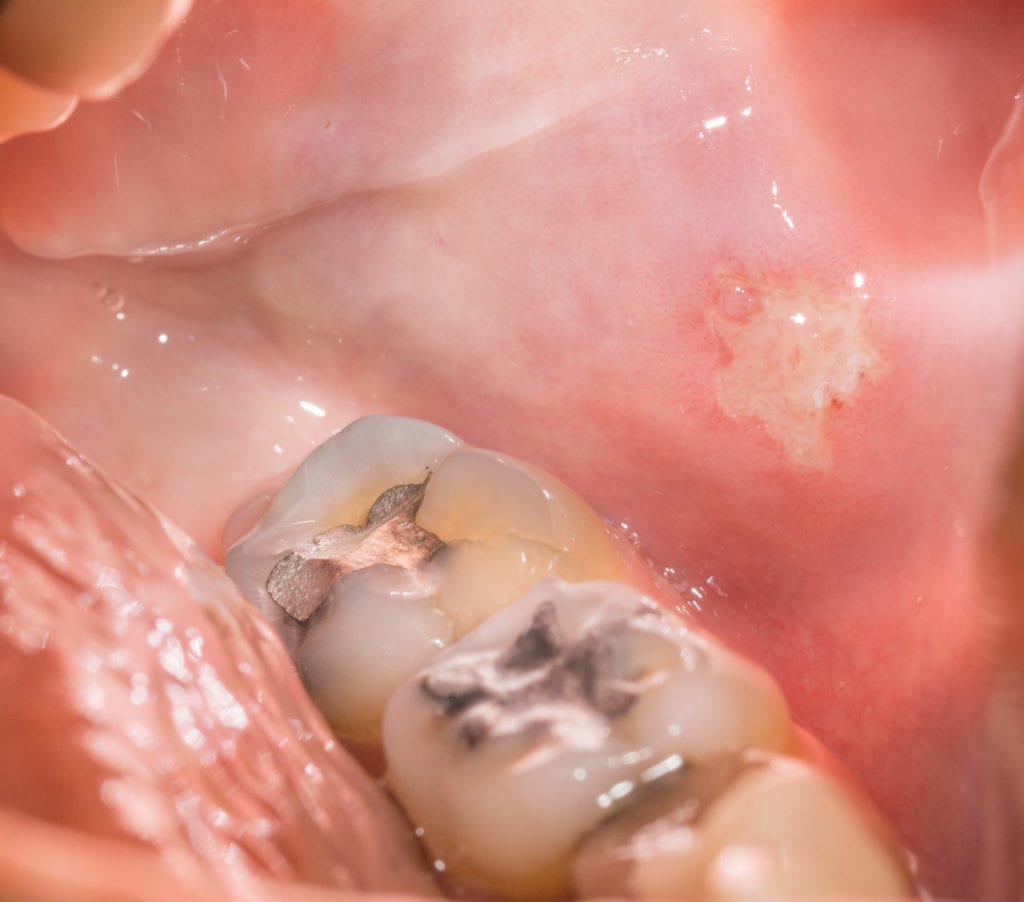 tannfyllinger av kvikksølv i molarer