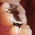 Tooth in mouth with saliva and silver-colored dental amalgam filling containing mercury