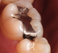 Diente en la boca con saliva y relleno de amalgama dental de color plateado que contiene mercurio