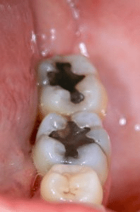 Datos de mercurio dental: saliva alrededor de los dientes en la boca con rellenos de color plateado, también conocidos como amalgamas dentales y empastes de mercurio