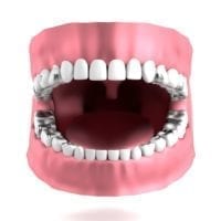 Graphic of mouth with dental amalgam silver mercury fillings in teeth