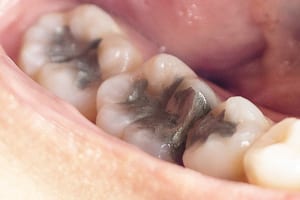 Photo of an amalgam dental filling which contains 50% elemental mercury
