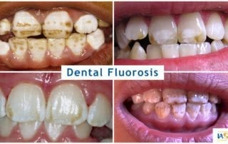examples of damage to teeth, including staining and mottling ranging from mild to severe, from dental fluorosis caused by fluoride