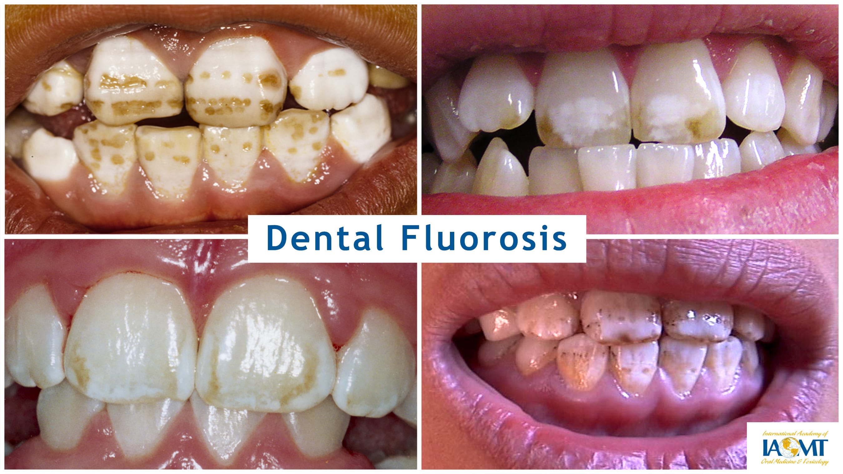 examples of damage to teeth, including staining and mottling ranging from mild to severe, from dental fluorosis caused by fluoride