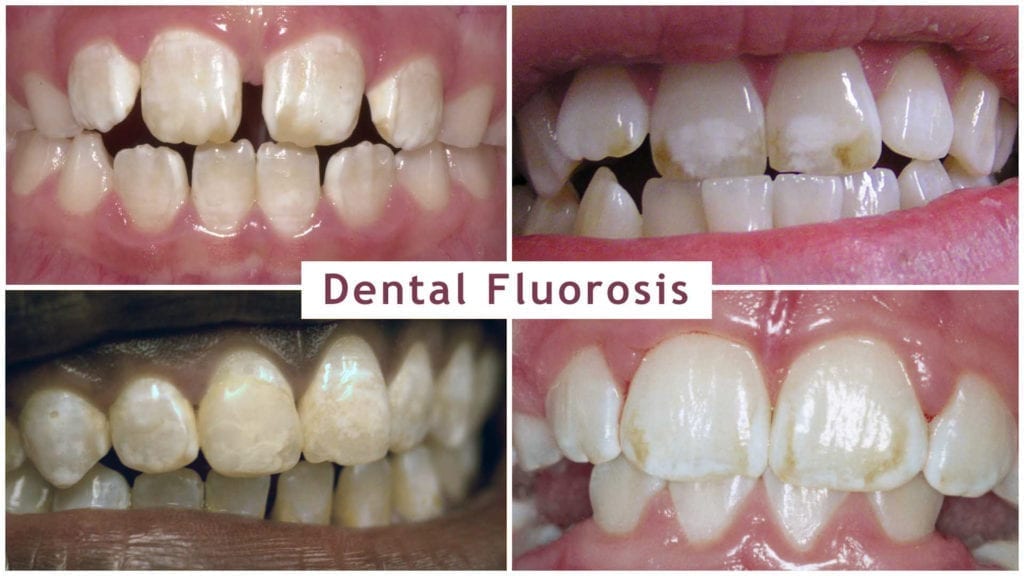 primeri poškodb zob, vključno z obarvanjem in lisami od blagih do hudih, zaradi zobne fluoroze, ki jo povzroča fluorid
