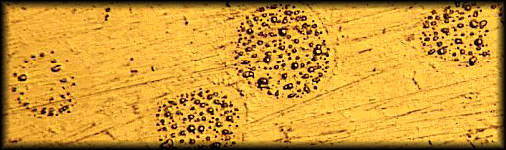 gouttes microscopiques de mercure sur un amalgame dentaire