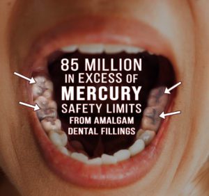 photo of open mouth with mercury dental amalgam fillings
