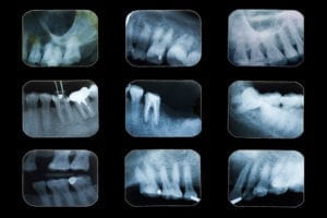película de radiografía dental