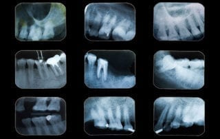 film radiographique dentaire